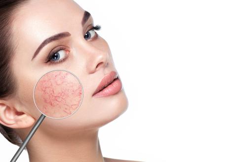 Thread Vein Treatment IPL Thread Vein Treatment
